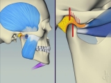 bad bite open close jaw motion