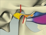 TMJ disc deterioration piper stages
