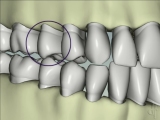 anterior bruxing mobility abfraction