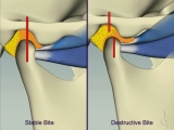 stable destructive pterygoid comparison