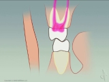 effects on nerves with no anterior guidance