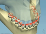 destructive tooth contacts