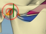 tmj distalization into fossa