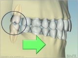 Bruxing effect on molars