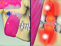 Help patients understand and see the pains caused by bruxing