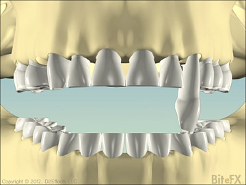 BiteFX V2 Interference to Destruction