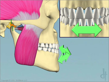 BiteFX V2 Knife Edge Anterior Wear